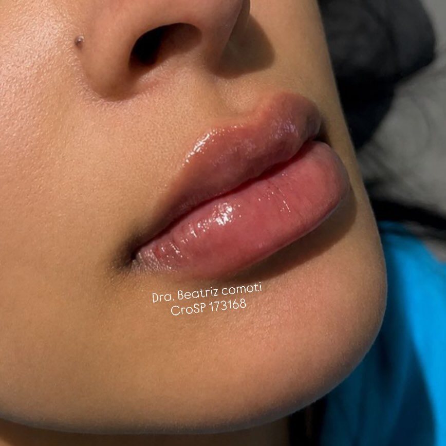 Preenchimento labial com resultado natural